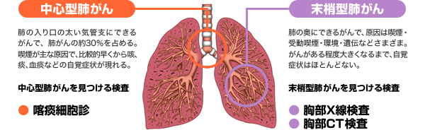 「中心型肺がん」と「末梢型肺がん」