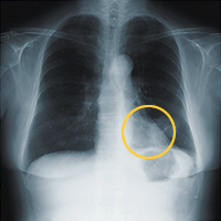 胸部X線検査