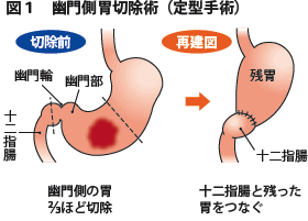 図1 幽門側胃切除術（定型手術）