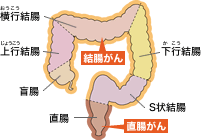 大腸がんの分類