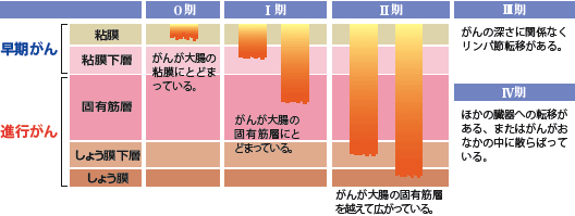 大腸がんのステージ