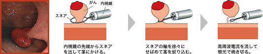 きのこ状のがんにはポリペクトミー