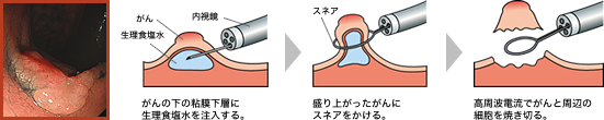 平坦ながんには内視鏡的粘膜切除術