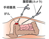 腹腔鏡手術