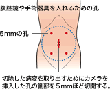 腹腔鏡手術でできる傷