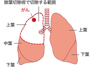 肺葉切除