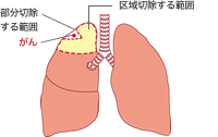 区域切除・部分切除