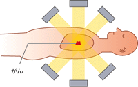 がんを重点的に狙い打つ定位放射治療