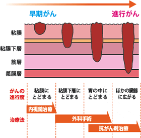 進行度による胃がんの治療法