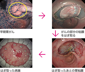 早期胃がんのESDのようす