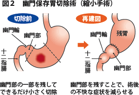 図2 幽門保存胃切除術（縮小手術）