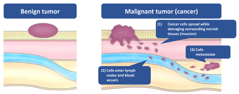 Malignant Tumor (Cancer) and Benign Tumor