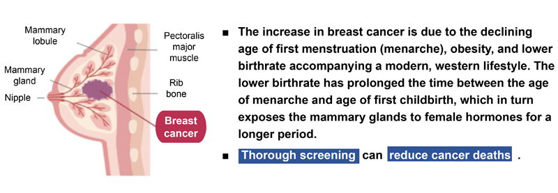 Breast Cancer